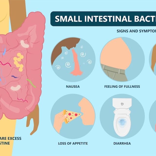 SIBO Treatment